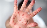 加拿大魁北克省确诊约十例麻疹病例